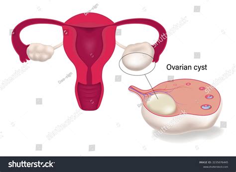 Ovarian Cyst Female Reproductive System Human Stock Vector Royalty