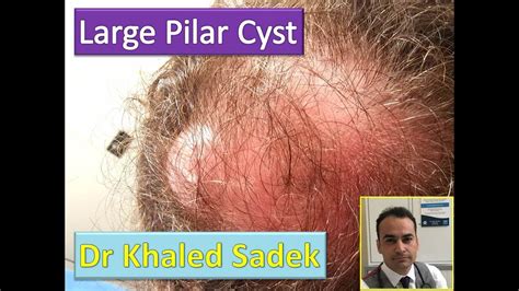 Pilar Cyst Leaking Scalp Cyst LipomaCyst Dr Khaled Sadek YouTube