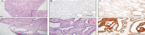 Utility of a PAX2 PTEN and β catenin Panel in the Diagnosi The