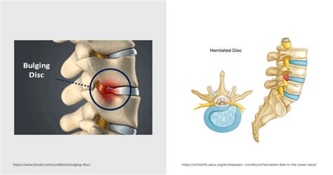 Bulging Disc Vs Herniated Disc Key Differences Explained Uprite Medical