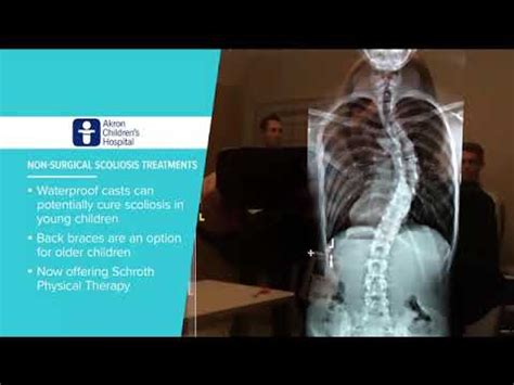 Non Surgical Scoliosis Treatments Tips To Grow By YouTube