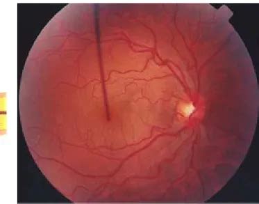 A Mácula e o Edema Macular PERFIL MORFOFUNCIONAL DE PACIENTES