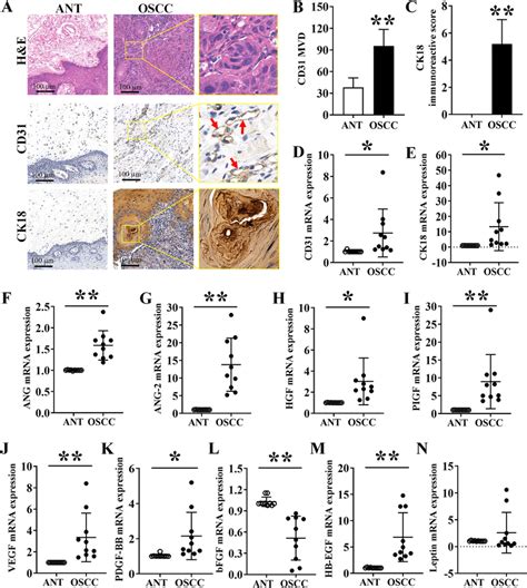 Histology And Ihc Analysis Of Angiogenic Markers In Oscc Tissues And