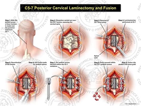 C5-7 Posterior Cervical Laminectomy and Fusion