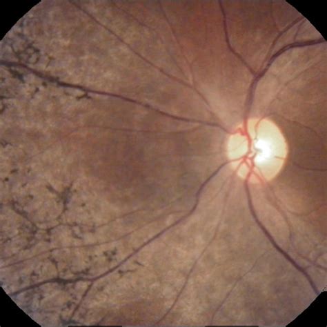 peripheral anterior synechiae in OD. Abbreviation: OD, right eye. | Download Scientific Diagram