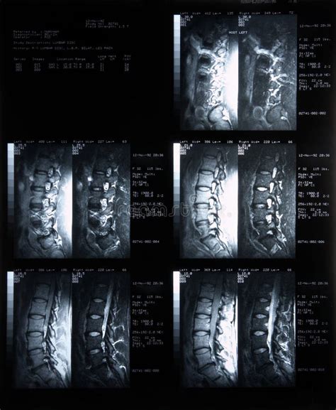 Magnetische Resonantie Beelden Van De Lumbale Wervelkolom Sagittal