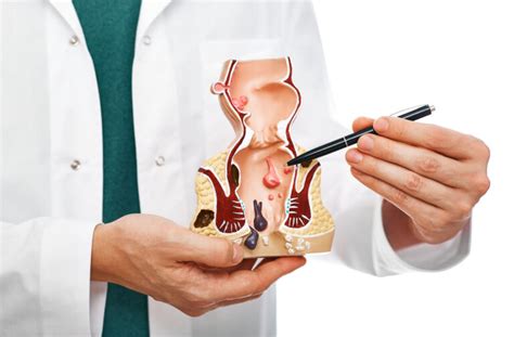 Fissura anal saiba o que é como tratar e prevenir
