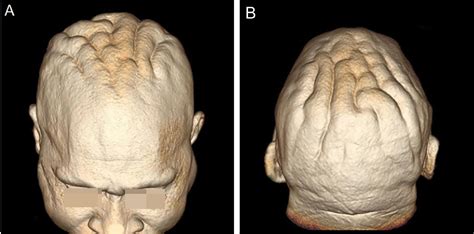 Scielo Brasil Cutis Verticis Gyrata A Cutaneous Finding In