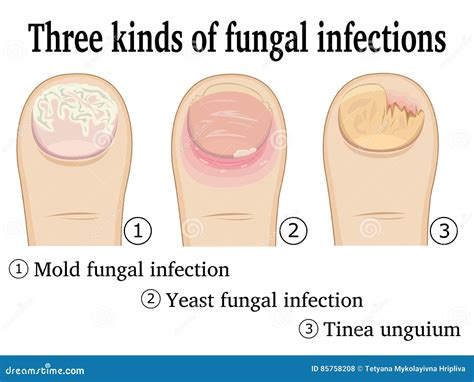 Three Kinds of Fungal Infections Stock Vector - Illustration of ...