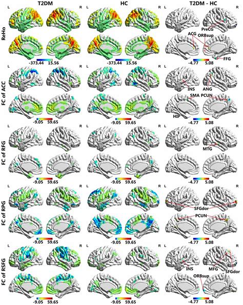 Frontiers Aberrant Brain Regional Homogeneity And Functional