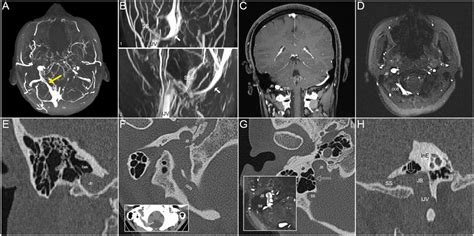 Frontiers Case Report Venous Pulsatile Tinnitus Induced By Enlarged Oblique Occipital Sinus