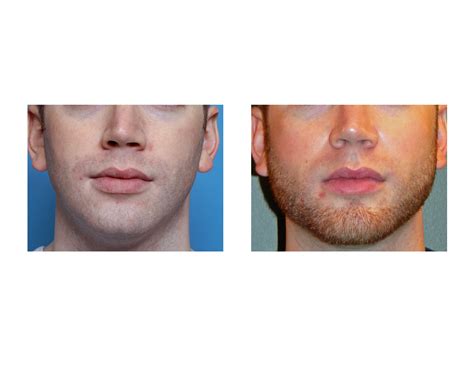 Square Chin Implants For Male Facial Augmentation Explore Plastic Surgery