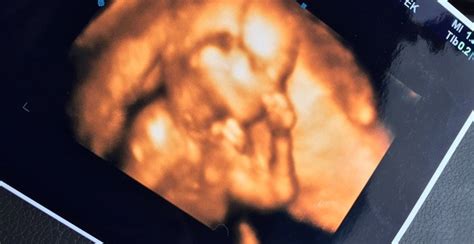 16 Week Gender Ultrasound 3d