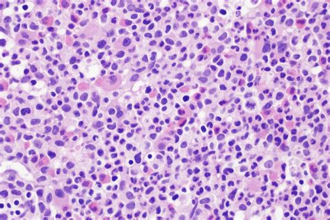 Demystifying Myeloproliferative Neoplasms Mpns Patient Care