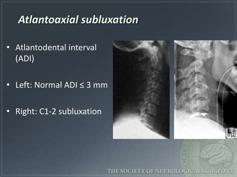 Ppt Emergency Spinal Radiological Assessment Powerpoint Presentation