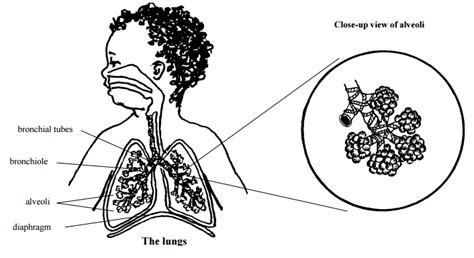 Respiratory distress syndrome (infant)