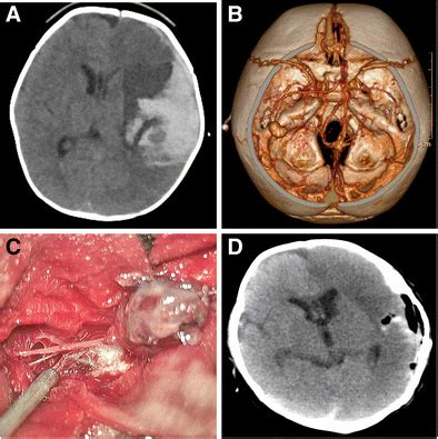 a CT scan of head demonstrated a 5.9 × 5.0 × 4.1 cm intraparenchymal ...