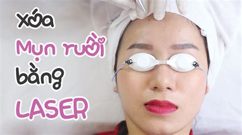 Xóa Nốt Ruồi Bằng Laser An Toàn Nhất Mỹ Liên Beauty Tôn Vinh Sắc đẹp