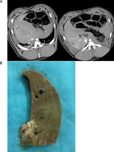 CT-Scans and macroscopic visualization of liver lesions. A) CT scans ...