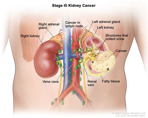 Renal Cell Cancer Treatment (PDQ®)–Health Professional Version ...