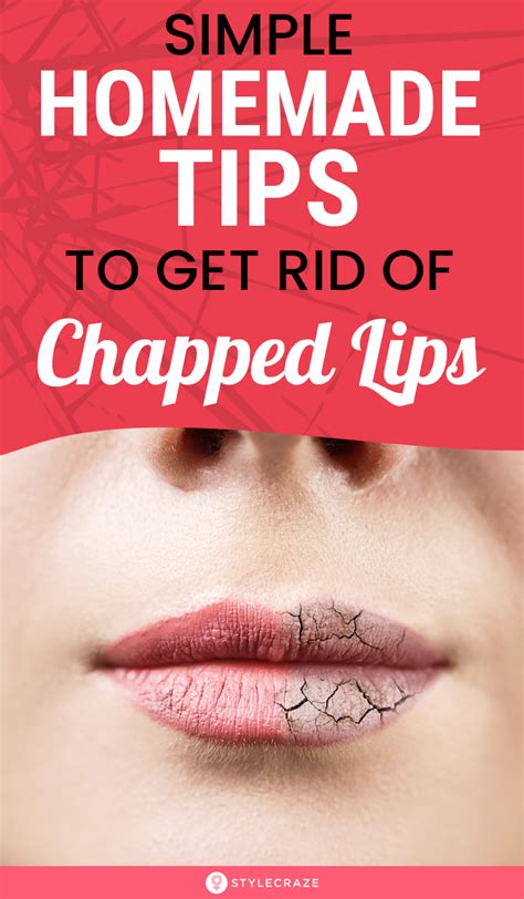 Get Rid Of Chapped Lips Fast Using These 11 Home Remedies Artofit