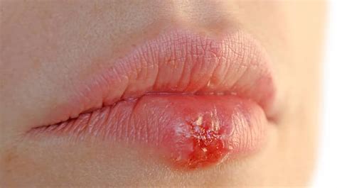 verschiedenen Möglichkeiten der Herpes Zoster Therapie