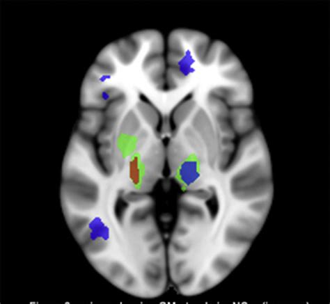 P2‐416 Structural Abnormalities Of Limbic System Serve As Potential