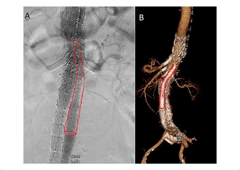 Intraoperative Angiography In Anterior View A And 3 Dimesional