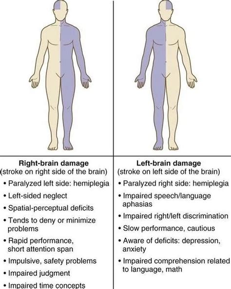 Hemiplegia: Definition, Causes, Symptoms Treatment, 57% OFF