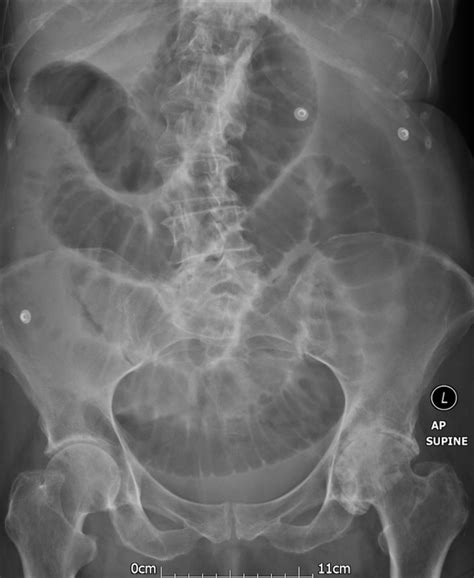 A Rare Case Of Incarcerated Femoral Hernia Containing Small Bowel And