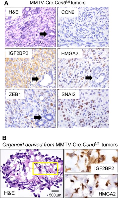 Mmtv Creccn6flfl Metaplastic Carcinomas Express Igf2bp2 Hmga2 And