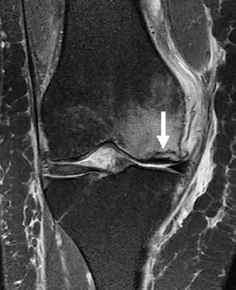 Subchondral Insufficiency Fracture Coronal Proton Densityweight Ed