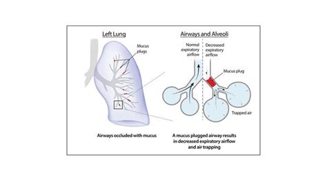 Jci Insight Persistent Mucus Plugs In Proximal Airways Are