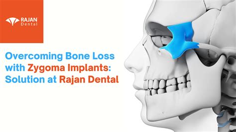 Overcoming Bone Loss with Zygoma Implants