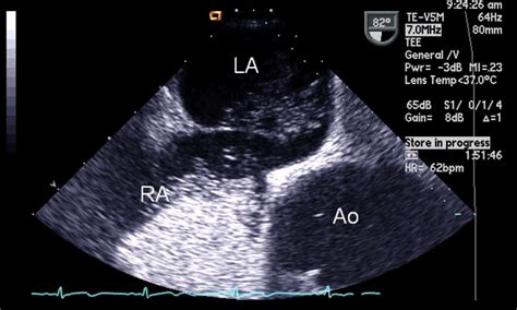 Pfo And Migraine New Study Zeros In On Atrial Septal Aneurysms