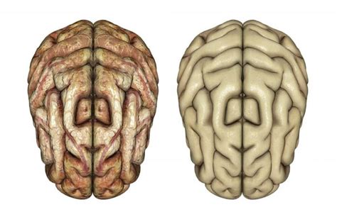 Qu Son Las Enfermedades Neurodegenerativas