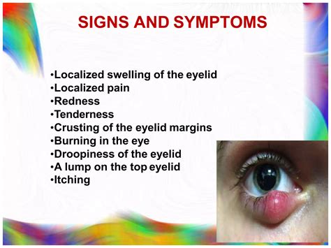 Stye or hordeolum | PPT