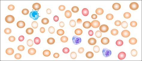 Anemia Part 9 Sideroblastic Anemia And Anemia Due To Chronic Diseases