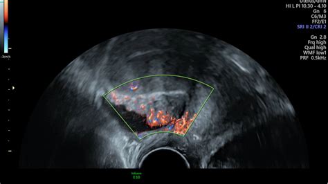 Endometriosis eLearn – Intelligent Ultrasound – eLearning