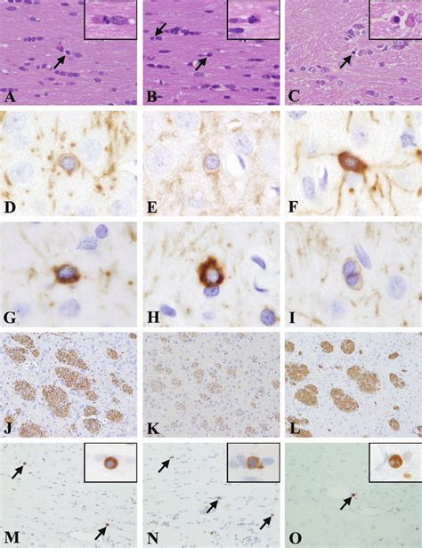 Oligodendroglial Apoptosis Characterized By Fragmented Nuclei And