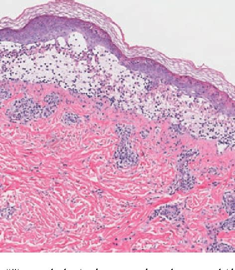 Table 1 From Clinical Features Diagnosis And Treatment Of Erythema Multiforme A Review For