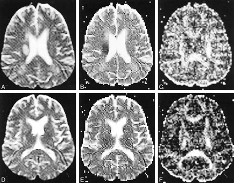 Diffusion Anisotropy Of The Internal Capsule And The Corona Radiata In