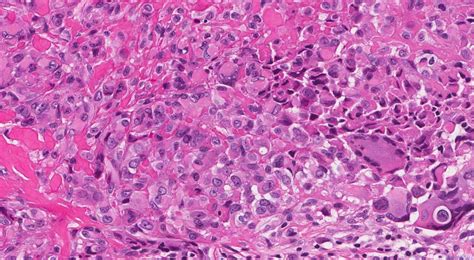 Epithelioid sarcoma | Ottawa Atlas of Pathology