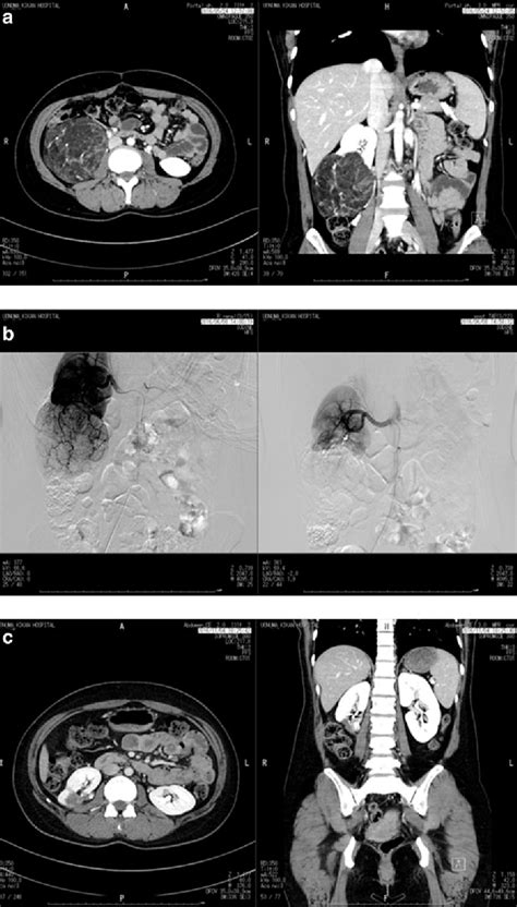 Figure 1 From Laparoscopic Retroperitoneal Nephron Sparing Surgery