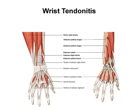 Tendonitis Of Wrist