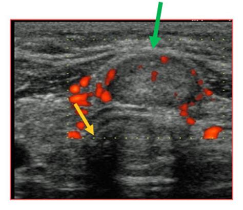 Follicular Thyroid Cancer Ultrasound