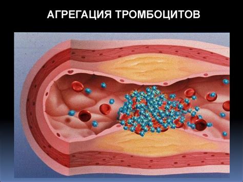 Атеросклероз - презентация онлайн