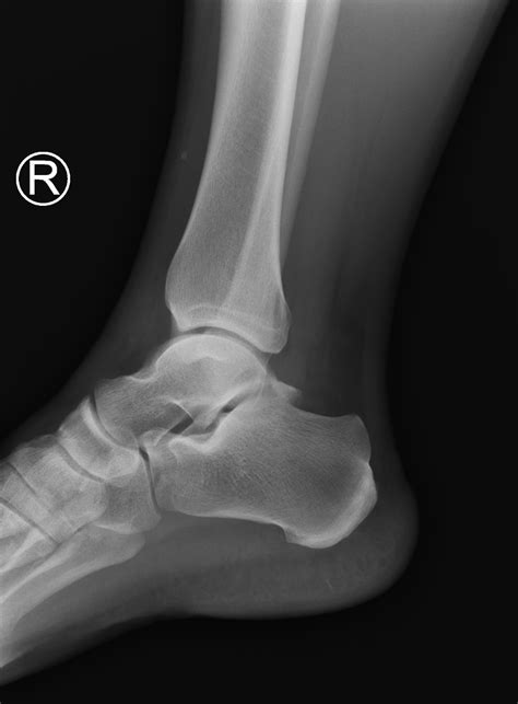 Osteochondral Fracture Of The Talar Dome Image Radiopaedia Org