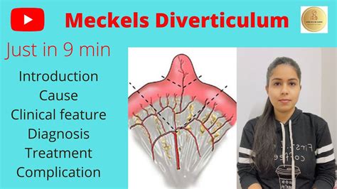 Meckel's diverticulum in Hindi- Cause, Symptoms, D/d, Investigation, T ...