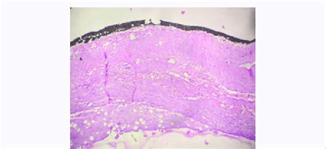 Histology picture of wall of excised ranula. | Download Scientific Diagram